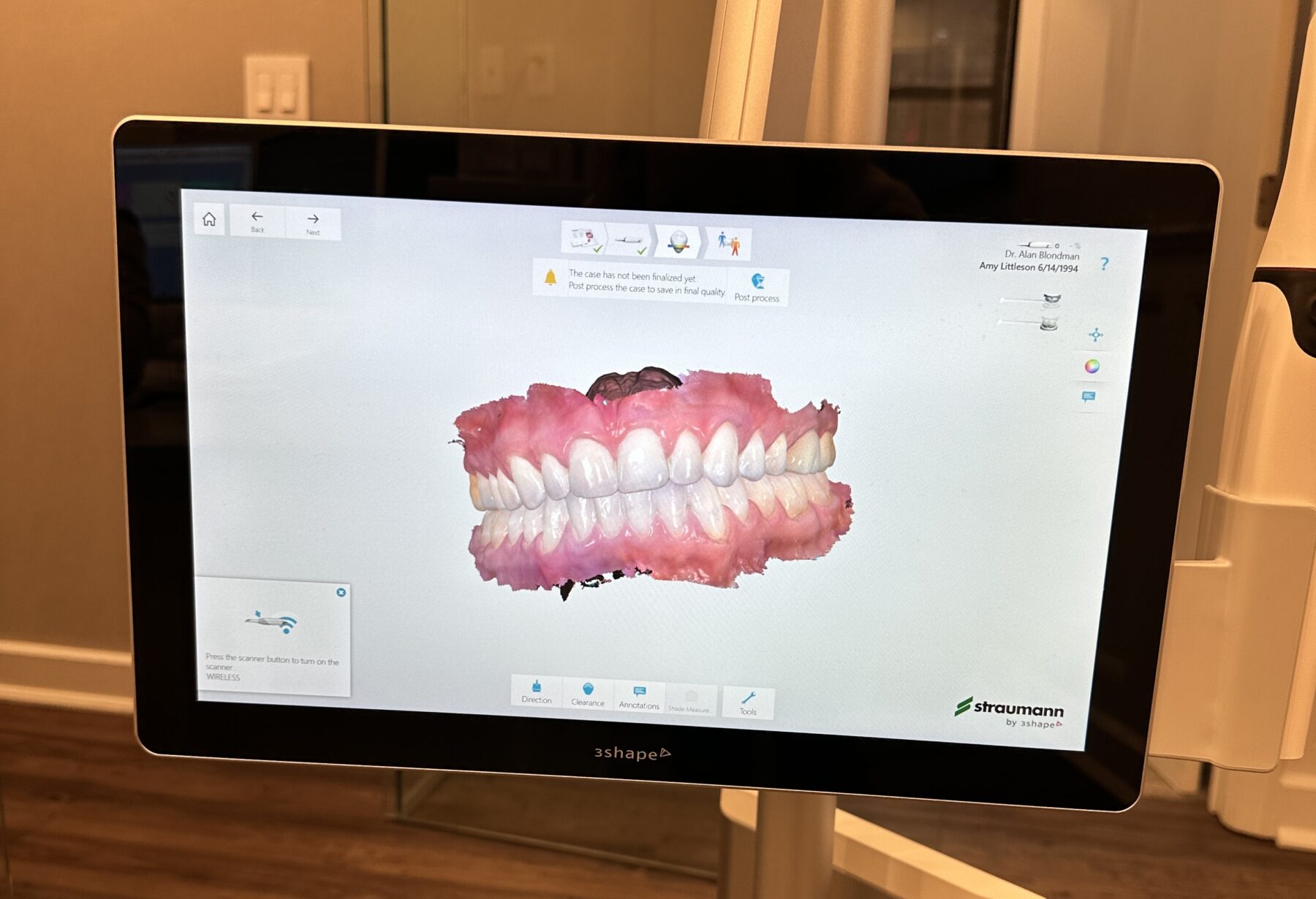 My Experience with ClearCorrect Aligners - Amy Littleson